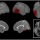 How the Brain "reacts" to EMDR?